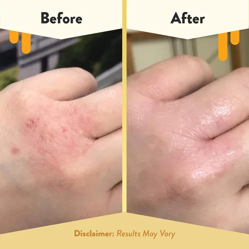 Vista 6 de ECZEMA HONEY Crema calmante original para la piel, jabón de avena y lavanda, paquete para pieles secas y sensibles - Libre de crueldad