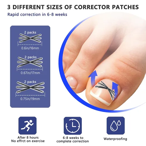 Vista 3 de Corrector de uñas encarnadas de aleación de titanio con diseño mejorado en forma de MI para alivio rápido del dolor, kit de herramientas