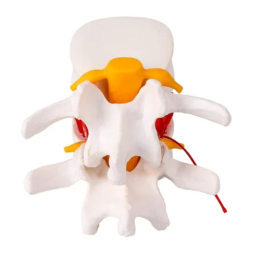 Vista 5 de Modelo de hernia de disco lumbar anatómica humana, modelo de hernia de disco lumbar de tamaño real - Modelo de columna lumbar para enseñar