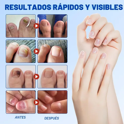 Vista 3 de Parches de uñas para uñas de los pies, 21 parches de cuidado de uñas de hidrogel, soporte y protección de uñas durante la noche, fácil de aplicar