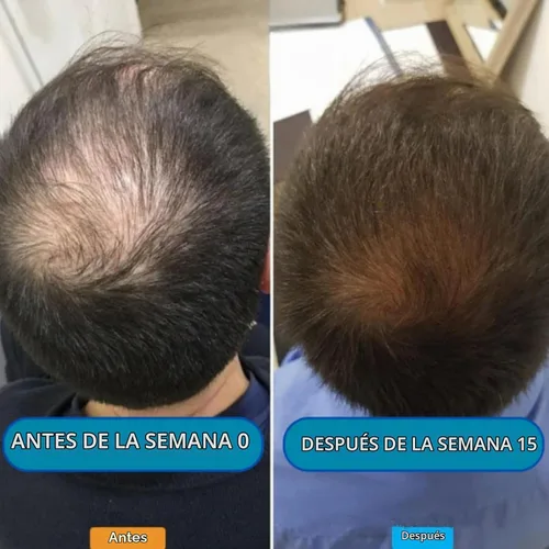 Vista 5 de Kit de renovación de cabello con micro infusión, suero para el cabello con ácido hialurónico, péptido y ampollas de suero botánico