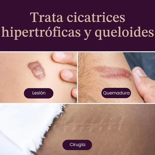 Vista 5 de Mederma Hojas de silicona de grado médico para cicatrices – Mejora la apariencia de cicatrices viejas y nuevas de lesiones, quemaduras y cirugía