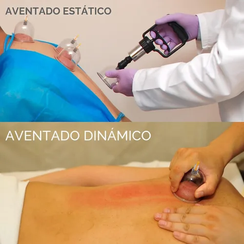 Vista 5 de Juego de ventosas para terapia de masaje, kit de ventosas para celulitis corporal, 24 ventosas de succión