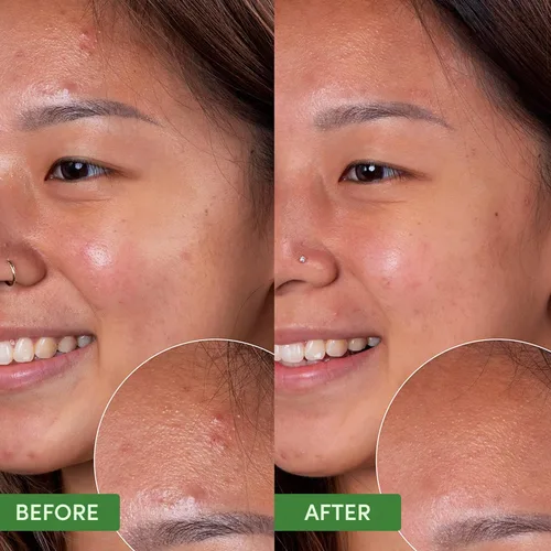 Vista 4 de Sand & Sky Lavado facial para acné con ácido salicílico, limpiador limpiador limpiador de control de aceite para piel grasa, limpiador facial