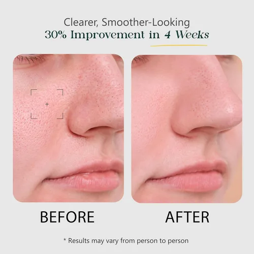 Vista 3 de Oré Lumière Suero facial refinador de poros – niacinamida, ácido salicílico, zinc PCA y ácido hialurónico – Limpia y aprieta los poros, controla