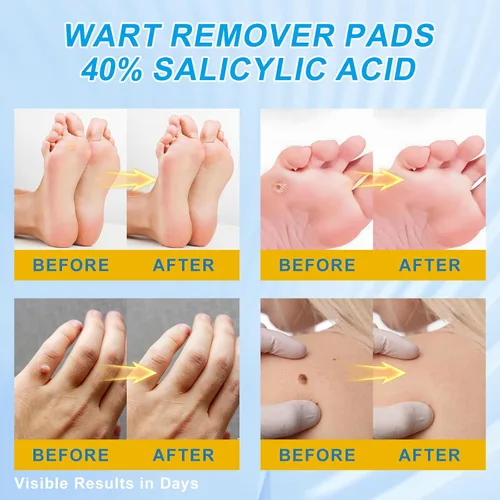 Vista 3 de WART Almohadillas removedoras de maíz para pies, 40% ácido salicílico, almohadillas removedoras de maíz para dedos de los pies, cuerpo