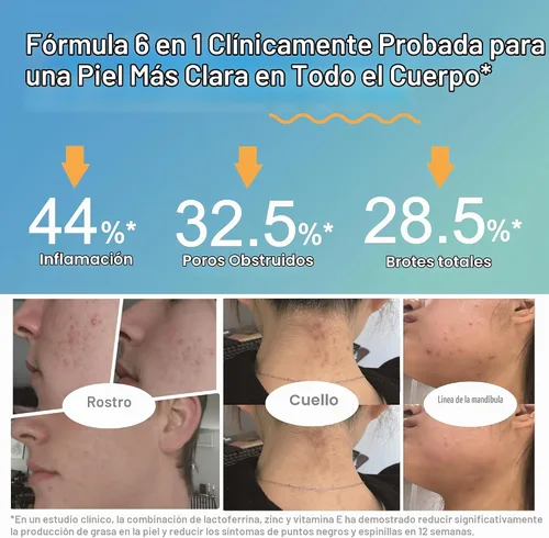 Vista 2 de Life-Space Probiótico para aliviar el acné + reequilibrio de la piel, fórmula científica 6 en 1 y 2 mil millones de UFC, apoya el control