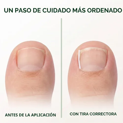 Vista 6 de Kit de tiras correctoras de uñas encarnadas, 10 piezas de tiras correctoras de uñas encarnadas, tiras alisadoras de uñas encarnadas, clips