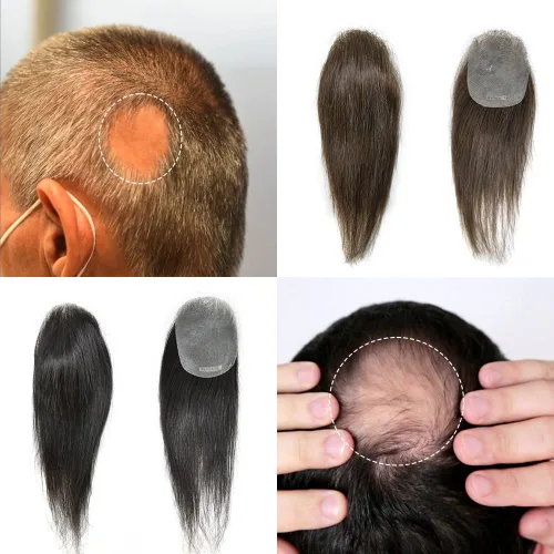 Vista 8 de Unidad de reemplazo de parche para cabello calvo en V de piel fina para línea capilar – 100% Remy humano transparente piel tupé sistemas frontales