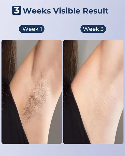 Vista 5 de Depilación láser IPL para mujeres y hombres, zafiro, enfriamiento de hielo, sin dolor, resultado duradero, dispositivo de depilación en casa