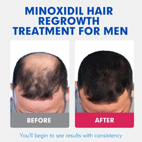 Vista 2 de Fytikal 5% de minoxidil para hombres tratamiento de crecimiento del cabello, solución tópica extra fuerte para adelgazamiento del cabello