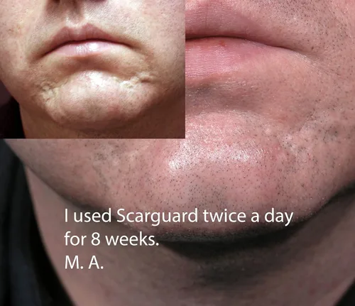 Vista 5 de Scarguard MD 0.5 onzas líquidas