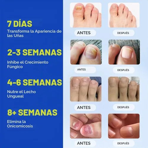 Vista 4 de Parches de uñas fúngicas, 21 unidades, cuidado de uñas durante la noche para uñas débiles y agrietadas, adherencia firme de 8 horas para uñas