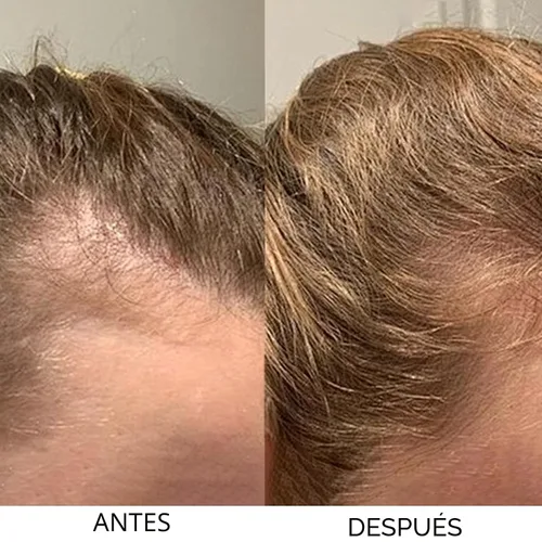 Vista 5 de Champú, champú de cebolla para el crecimiento del cabello, con aceite de romero, cebolla roja, canela, previene eficazmente la pérdida de cabello