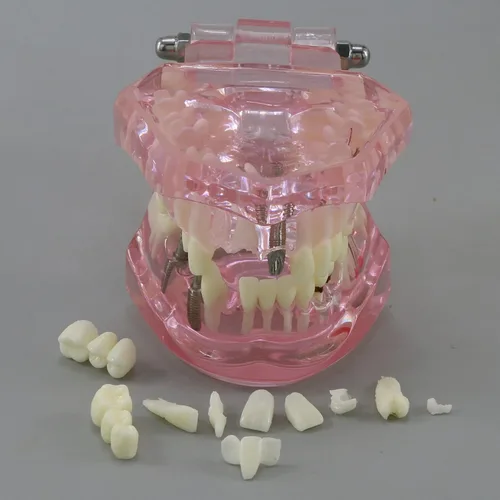 Vista 7 de Demostración oral del puente de la patología del color rosado de los dientes de Typodont de la restauración del implante dental M2001