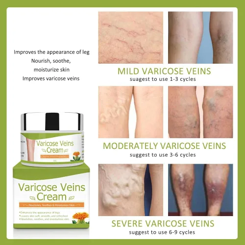 Vista 2 de Crema para venas varicosas, crema corporal, crema natural y pura para venas varicosas para piernas elimina las venas varicosas y las arañas