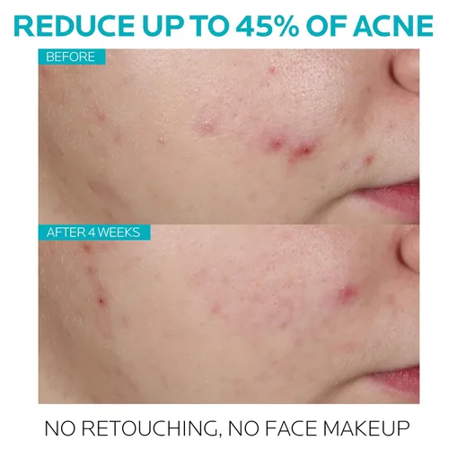 Vista 8 de La Roche-Posay Effaclar - Suero de ácido salicílico al 1,5%, tratamiento para el acné para la cara con ácido glicólico y niacinamida, suero