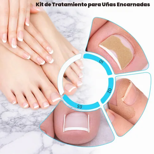 Vista 4 de Kit de eliminación de uñas encarnadas mejorado 2026, tratamiento de uñas encarnadas, corrector de uñas encarnadas de acero inoxidable, herramienta
