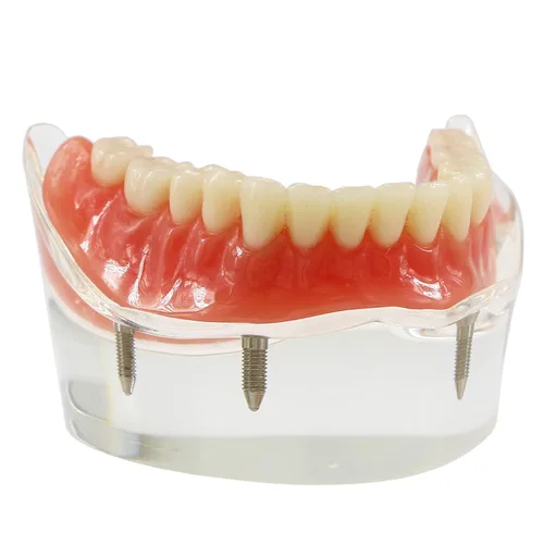 Vista 2 de Demostración inferior inferior inferior de la restauración del modelo M6003 Typodont Sobredentadura 4 implantes inferior inferior de los dientes