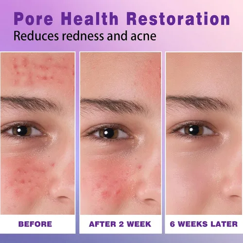 Vista 5 de Sefralls Crema facial de ácido azelaico 14%, crema facial avanzada de ácido azelaico – Alivio del enrojecimiento y reducción del enrojecimiento