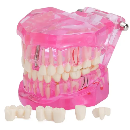 Vista 8 de Modelo de dientes de implante dental transparente - Modelo de dientes de enfermedad transparente Modelo de dientes patológicos con dientes
