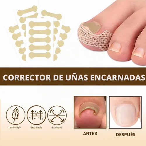 Vista 2 de Juego de corrector de uñas encarnadas con lupa y tiras correctoras, juego de herramientas profesionales de tratamiento de uñas encarnadas, cuidado