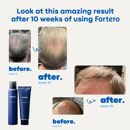 Vista 2 de Champú Fortero de ácido carbónico - Promueve el crecimiento del cabello saludable, más completo y grueso para hombres, fórmula antiadelgazamiento