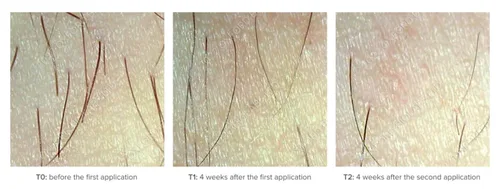Vista 3 de Sistema de inhibición del cabello – Inhibidor del cabello - después de la depilación, depilación con cera - Nutre la piel