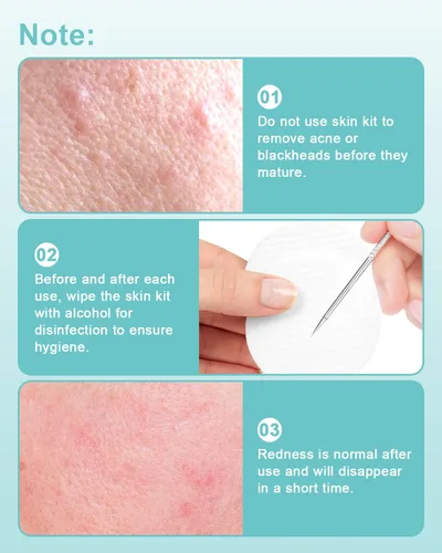 Vista 4 de Herramientas removedoras de puntos negros para Face EZBASICS Profesional Extractor de Comedones de Acero Inoxidable para Manchas y Puntos Blancos