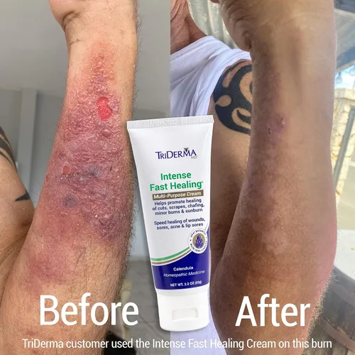 Vista 2 de TriDerma Crema multiusos intensa de curación rápida para cortes, rasguños, llagas, rozaduras, quemaduras menores y quemaduras solares