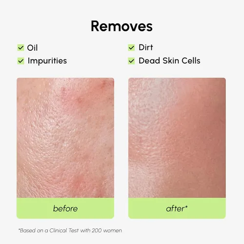 Vista 5 de MAREE Tónico Exfoliante con Ácido Salicílico – Exfoliante Facial AHA BHA & Limpiador de Poros – Exfoliante Líquido BHA para Cuidado de Sebum y Piel